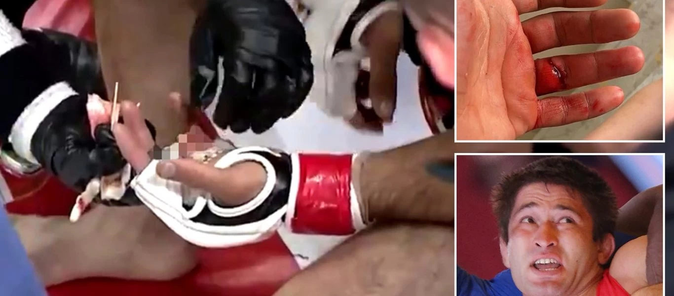 Σοκαριστικός τραυματισμός σε αγώνα ΜΜΑ - Κόπηκε το δάχτυλό του & βγήκε ανακοίνωση για τον... εντοπισμό του (φώτο-βίντεο)